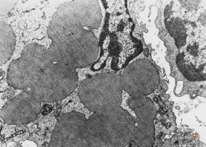 F,32y. | lymphadenopathy - clin. dysglobulinaemia F,32y. | lymphadenopathy - clin. dysglobulinaemia